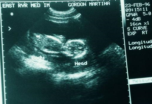 怀孕4个月b超单图片图片