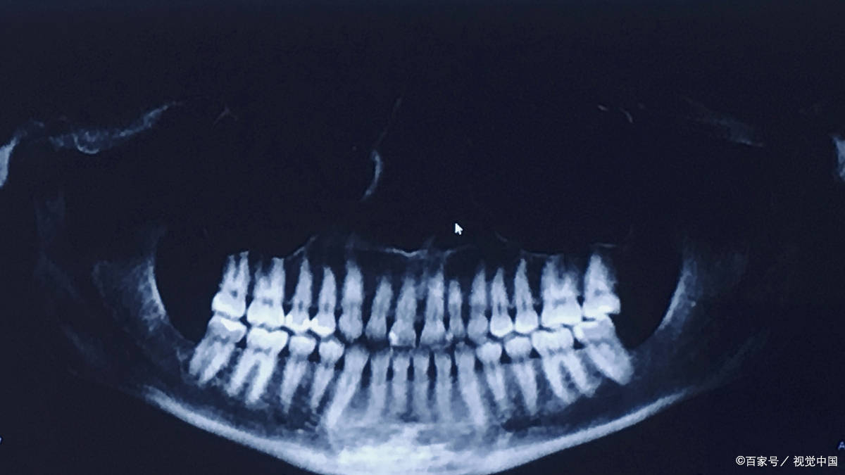 牙槽骨吸收,牙齿松动等情况,而牙槽骨吸收程度只能通过x光片进行评估