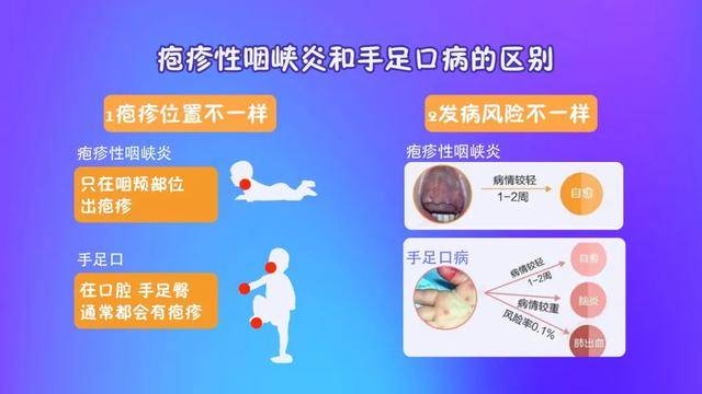 延伸——皰疹性咽峽炎咽喉腫痛的元兇皰疹性