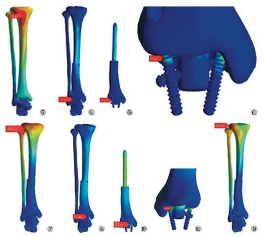 3d 打印踝关节融合假体重建胫骨远端肿瘤切除后骨缺损