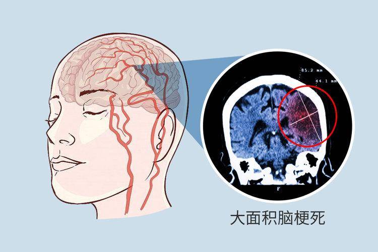 56歲男子深夜腦梗癱瘓,再次提醒:中老年人晚飯後,要少