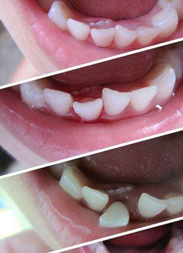 乳牙滞留可能会导致牙齿畸形,口腔卫生保持不到位也会增加龋齿的几率