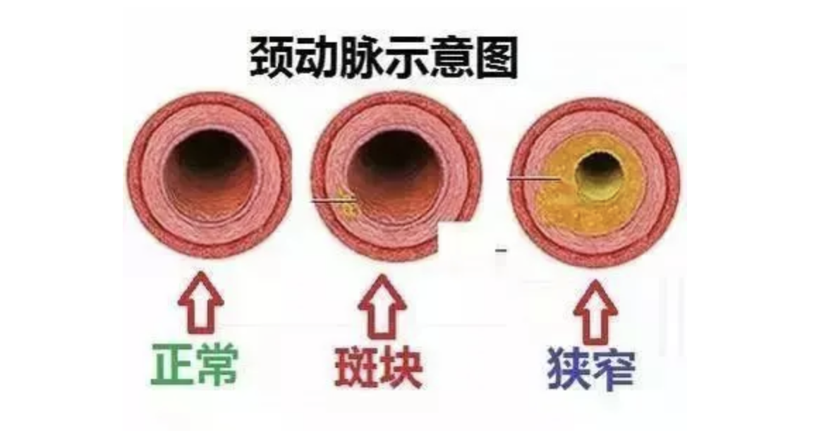 颈动脉的图片和示意图图片