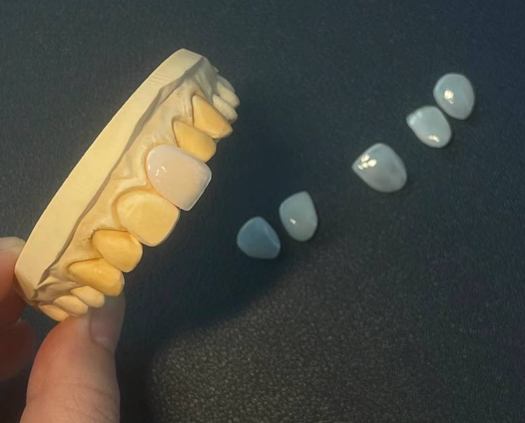 美伦美咖瓷贴面是不是很贵?能保持多久?_牙齿_全瓷_口腔