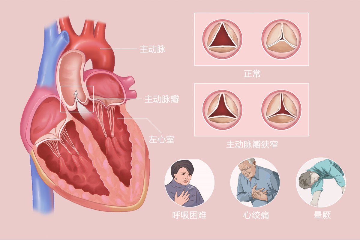 【常见老年疾病科普】主动脉瓣狭窄