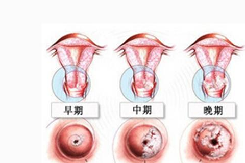 宫颈癌分泌物症状图片图片