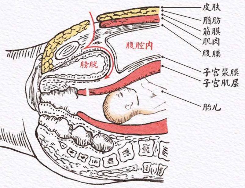 腹膜折返示意图图片