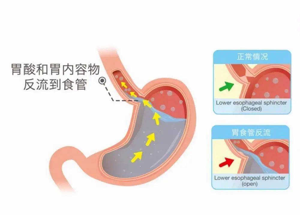 食管_治疗_进行