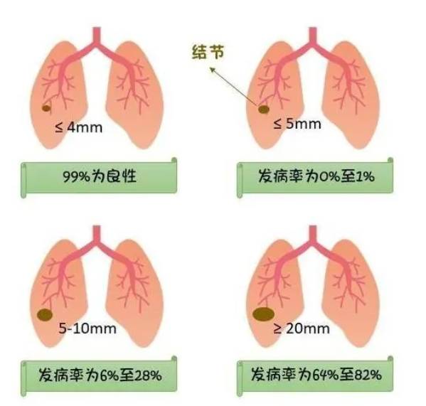 肺结节有什么症状图片