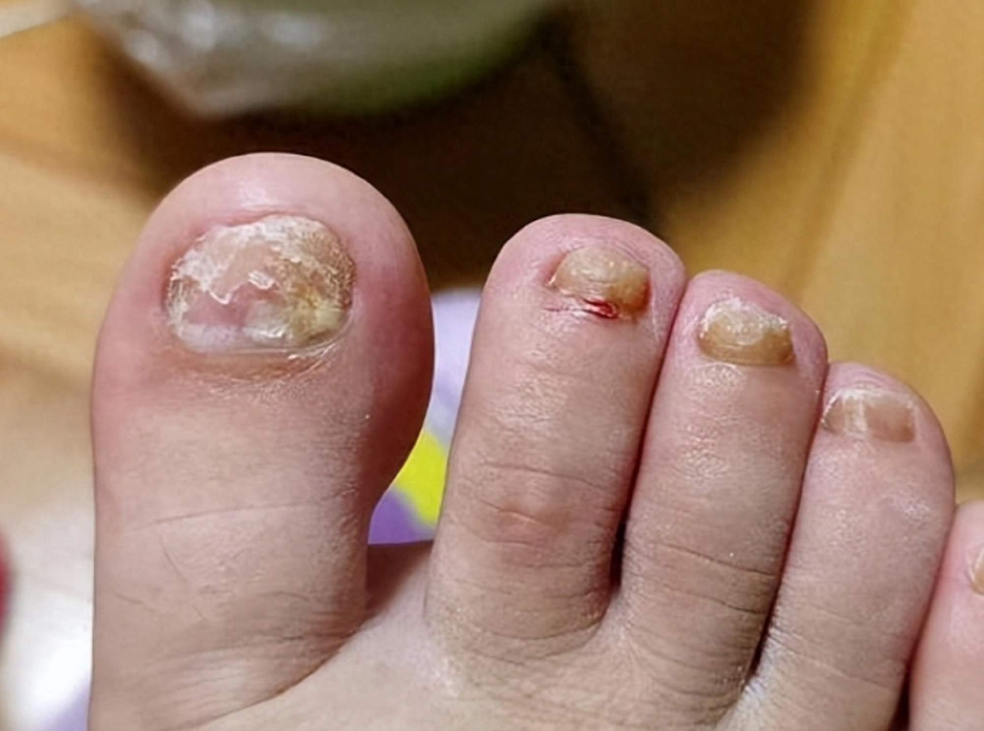 得了灰指甲太难缠!3招教你根治不反复,居家就能操作!_真菌_治愈_方法