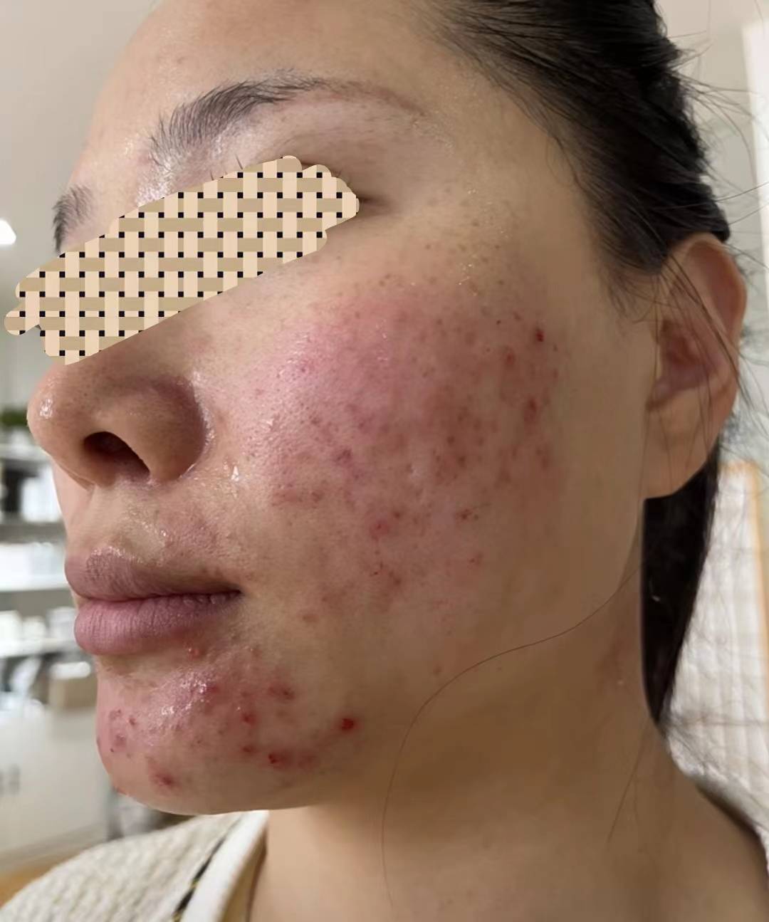 痤疮患者自用妙招分享!不愧是国货之光!红肿痘痘一次治好!