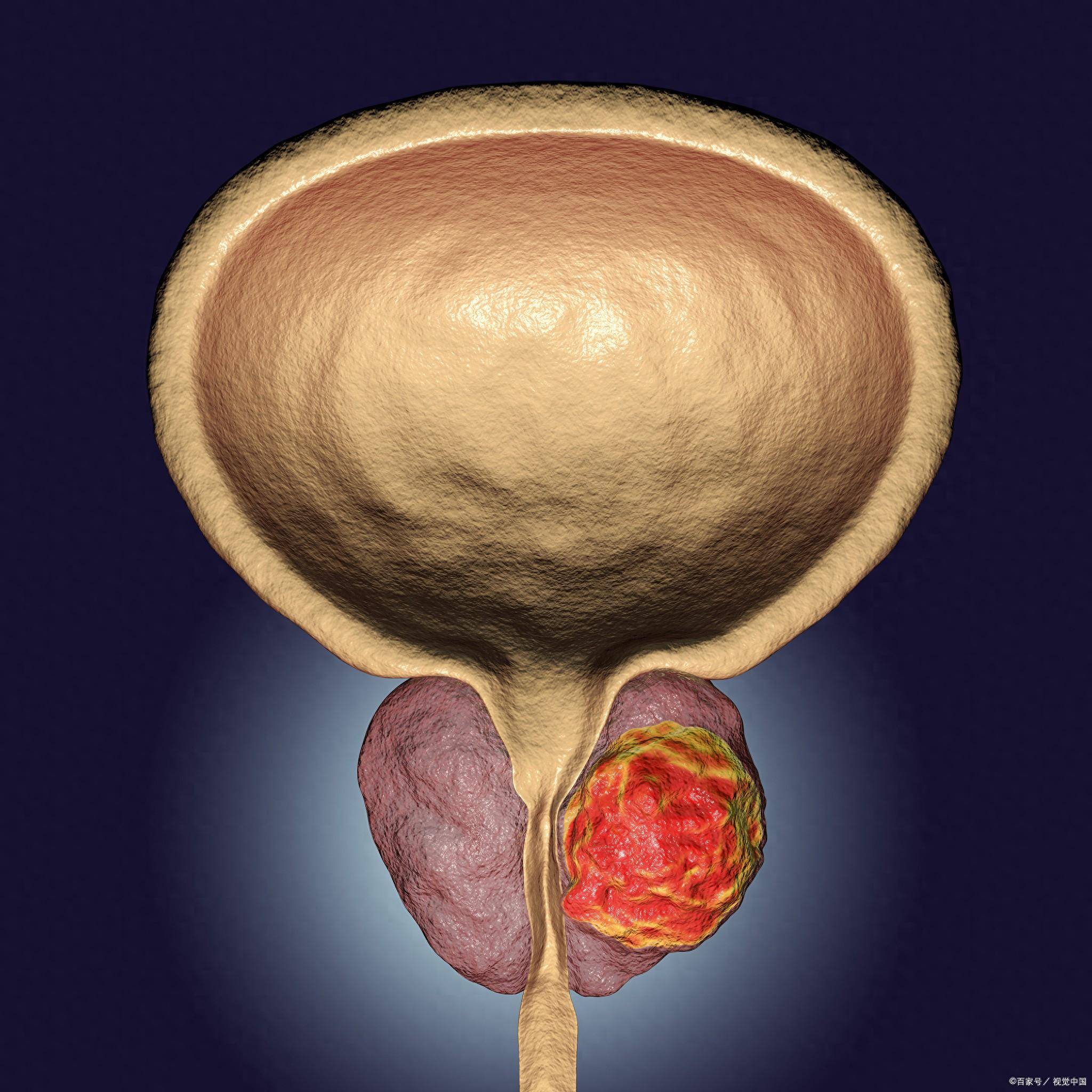 前列腺癌的早期信号图片