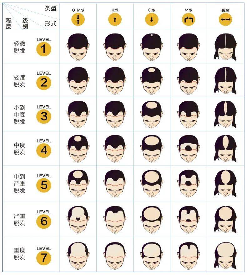 有植介:你的脱发到什么程度了?