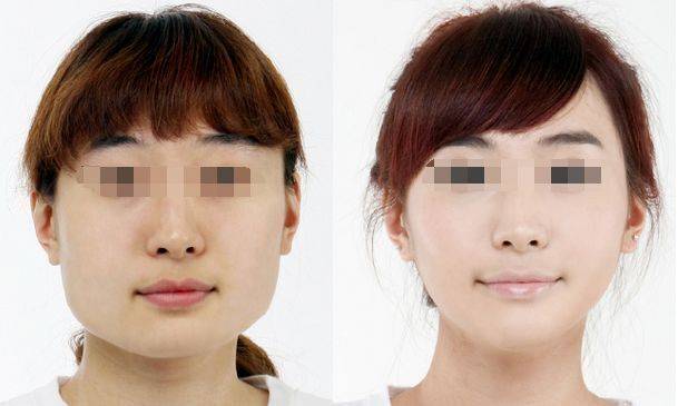 下颌角整形手术术后效果!_面部_切口_肌肉