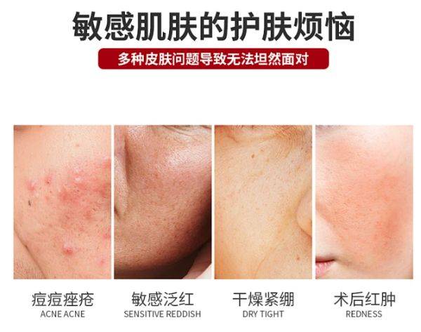 敏感肌必备!大揭秘,一补水二保湿,打造强大肌底屏障!_肌肤_皮肤_宝宝
