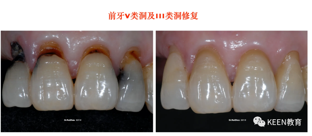 牙肉与牙齿分离图片图片