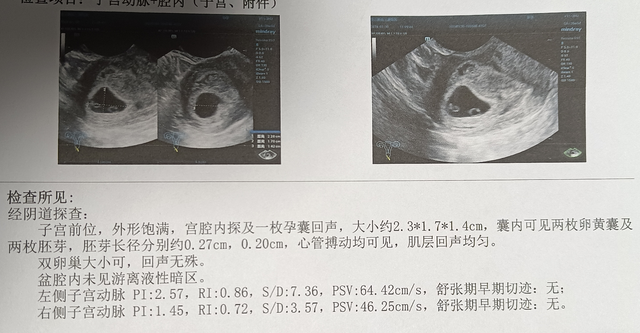 异卵双胞胎早期b超图图片