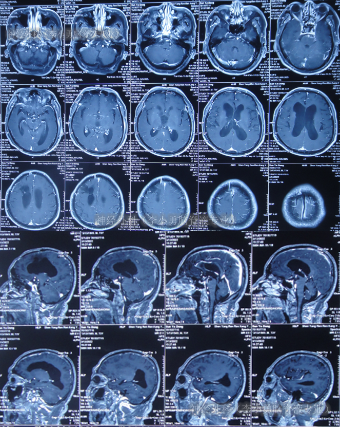 脑囊虫手术37年后的2年半中,脑积水分流术感染脑脊液内有6种细菌_治疗