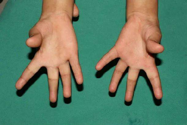 系统性硬皮病—多学科疾病:临床特征和治疗_皮肤_影响_lcssc