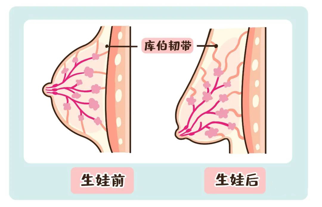 哺乳是不会引起乳房下垂的