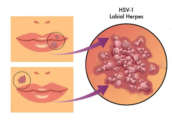 女性hsv病毒症状图片图片