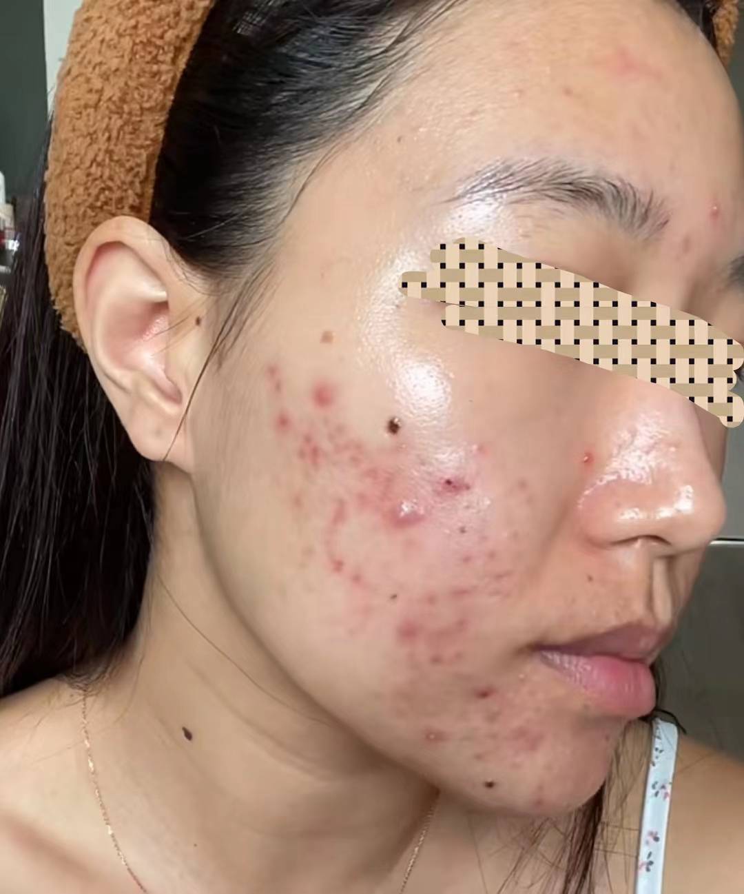 曝光去痤疮痘痘最简单的方法!每天成本几毛钱!一次治好没痘印!