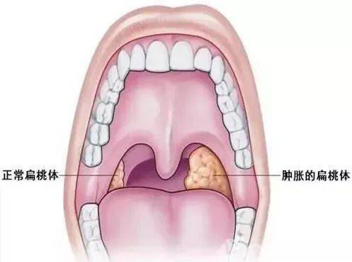 孩子扁桃体发炎了,家长生活中怎么做好护理?