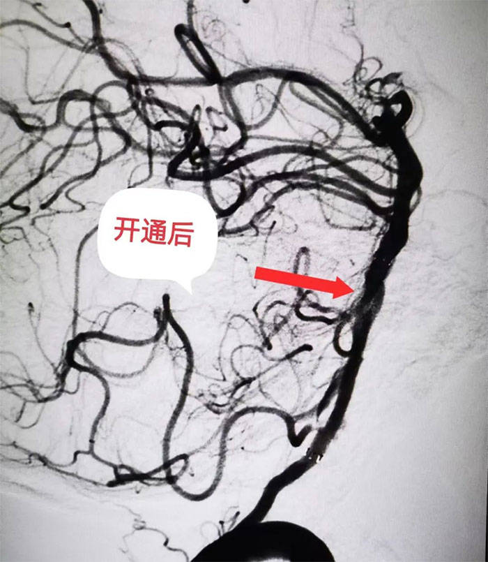 中年男子一觉醒来突发脑干梗死 多学科救治顺利脱险_患者_张静波_循环