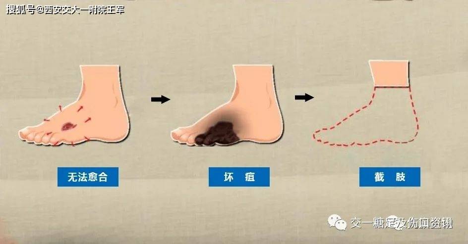 血管里的糖会一步步腐蚀你的双脚_患者_血液_病变