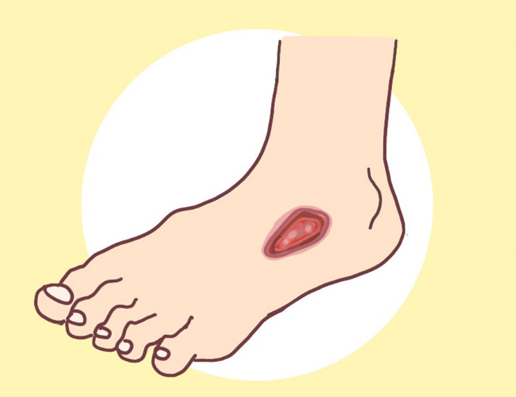 长期高血糖可引起皮肤及外阴瘙痒,皮肤真菌感染(如手癣,足癣,股癣