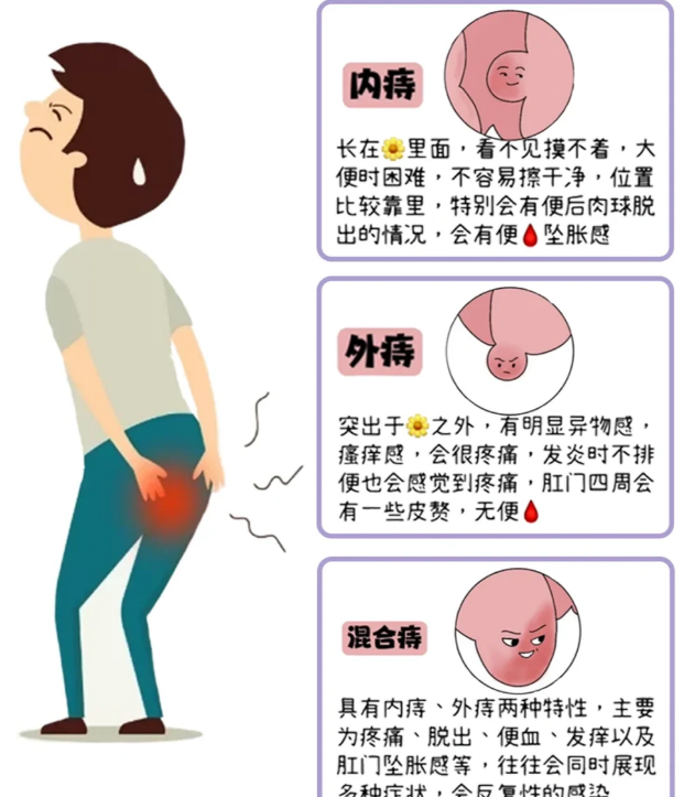 到底什么样的人群更容易得痔疮呢?_补充_肠道_代谢