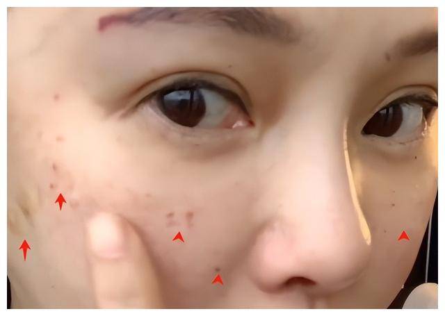 秦昊老婆飞韩国打水光针,56岁伊能静针眼满脸,感叹疼痛难忍.