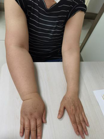 淋巴_阿姨_进行