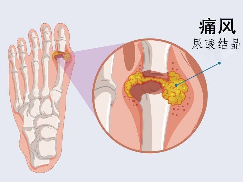 痛风卡通高清图片大全图片