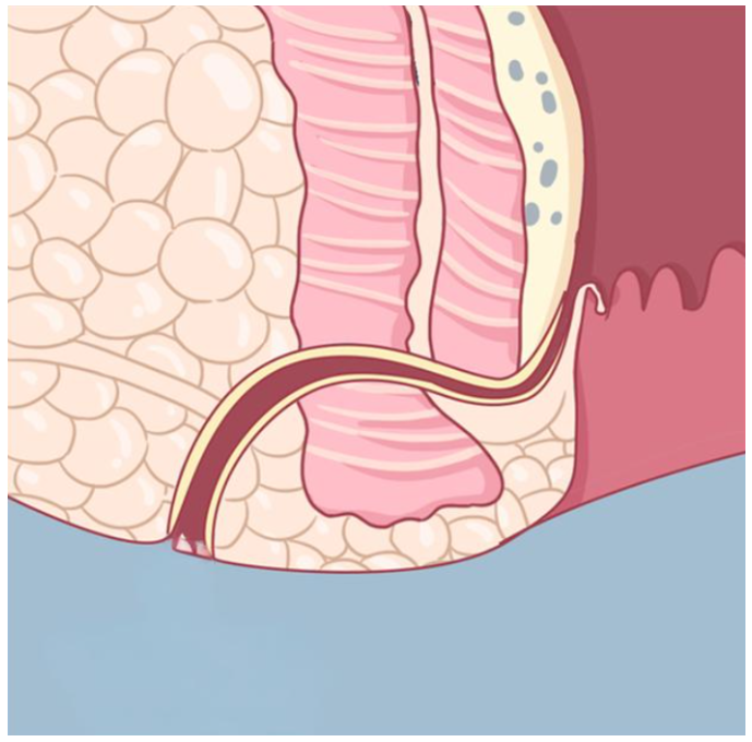 肛周毛囊炎误诊肛瘘图片