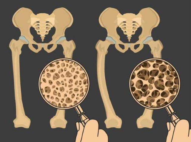 多走路能预防骨质疏松?提醒 少吃这3类食物
