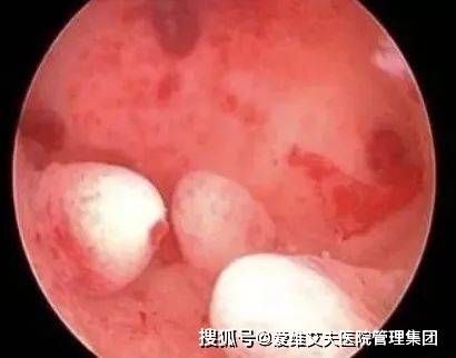 5类助孕人群建议检查下_子宫_手术_内膜
