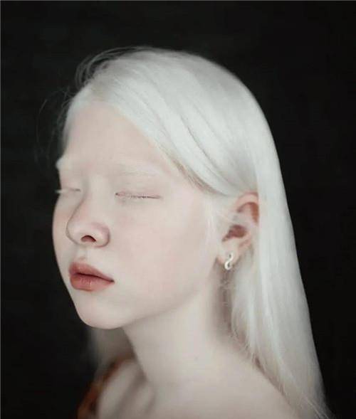 原创一对罕见的白雪公主生活中受尽歧视拍一组照片后惊艳众人