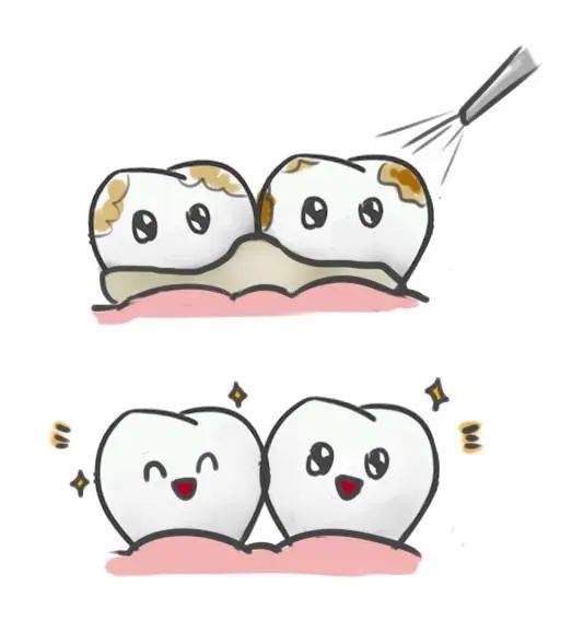 洗牙真相揭秘:牙缝变大,敏感不适,都是牙结石惹的祸?