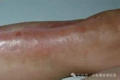 温阳祛痹方剂系统性硬皮病效果怎么样