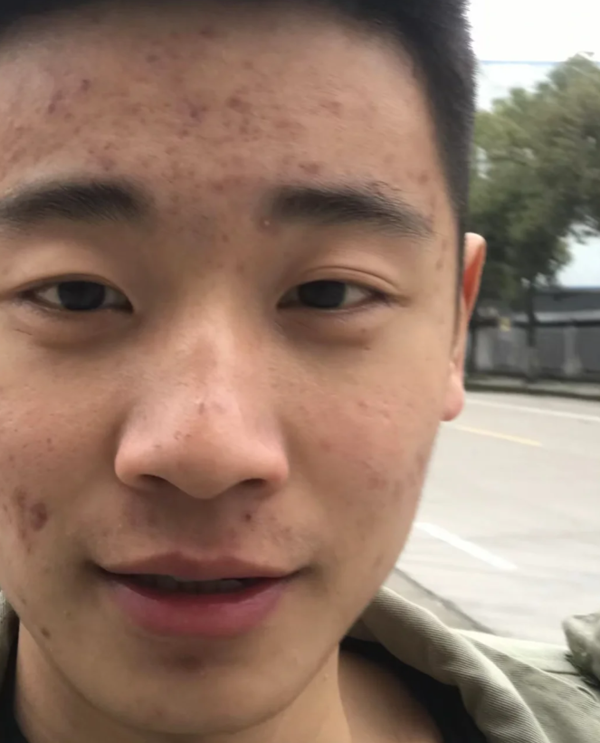 男士痘痘上岸激动的要哭了