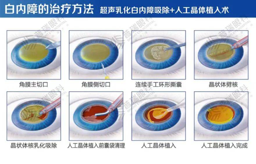 如今的白内障手术快捷且安全,术后第二天就可以看清楚,只要患者觉得