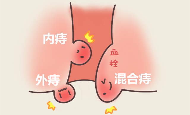 儿童大便时肛门图图片