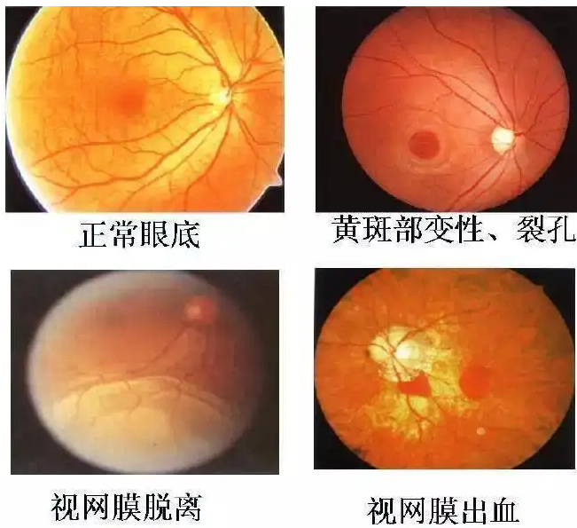 想做近视手术,还得先打眼底激光?贵阳近视手术靠谱吗?_视网膜_黄斑_玻