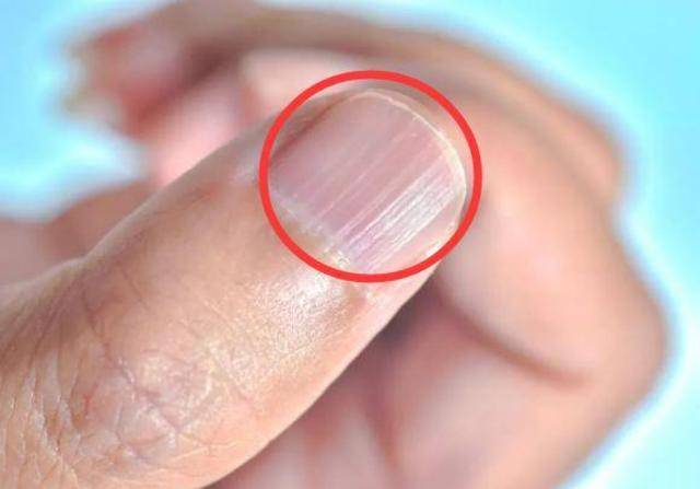 原创为什么指甲上有竖纹指甲若出现4种异常或是几种问题的信号