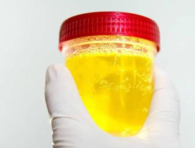 原创尿毒症是怎么来的医生提醒如有2处发臭晚上尽量坚持3不要