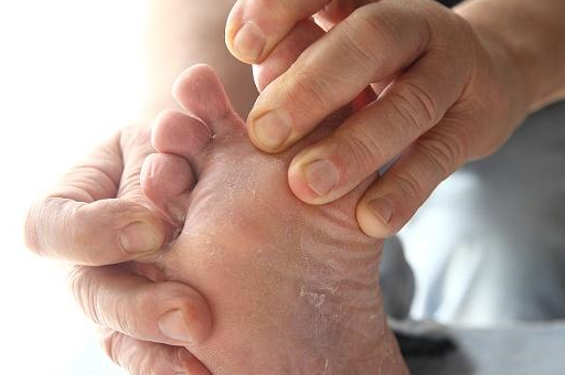 原创这个冬天你也要注意脚气的发生