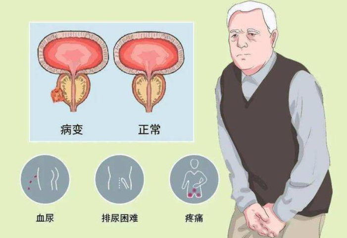 中瑞恩次方:加强早筛意识,助力前列腺癌防控
