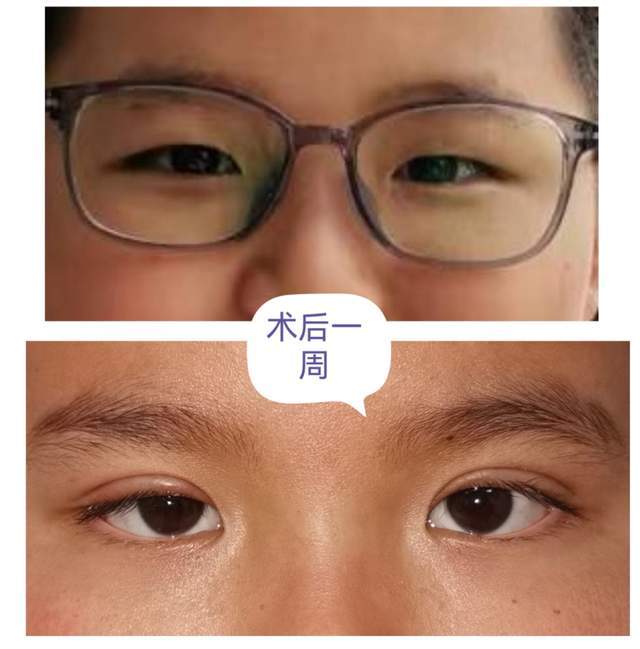 术后一周)(▲ 双下睑内翻倒睫—术后一月)六,不做手术会怎样呢?