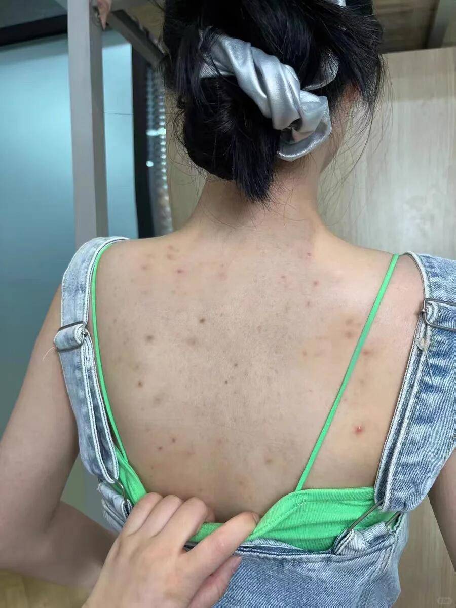 皮肤_痘痘_严重
